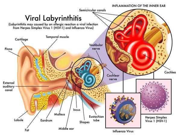 Vertigo After Flu